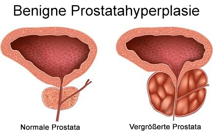 prostatahyperplasie komplikationen)